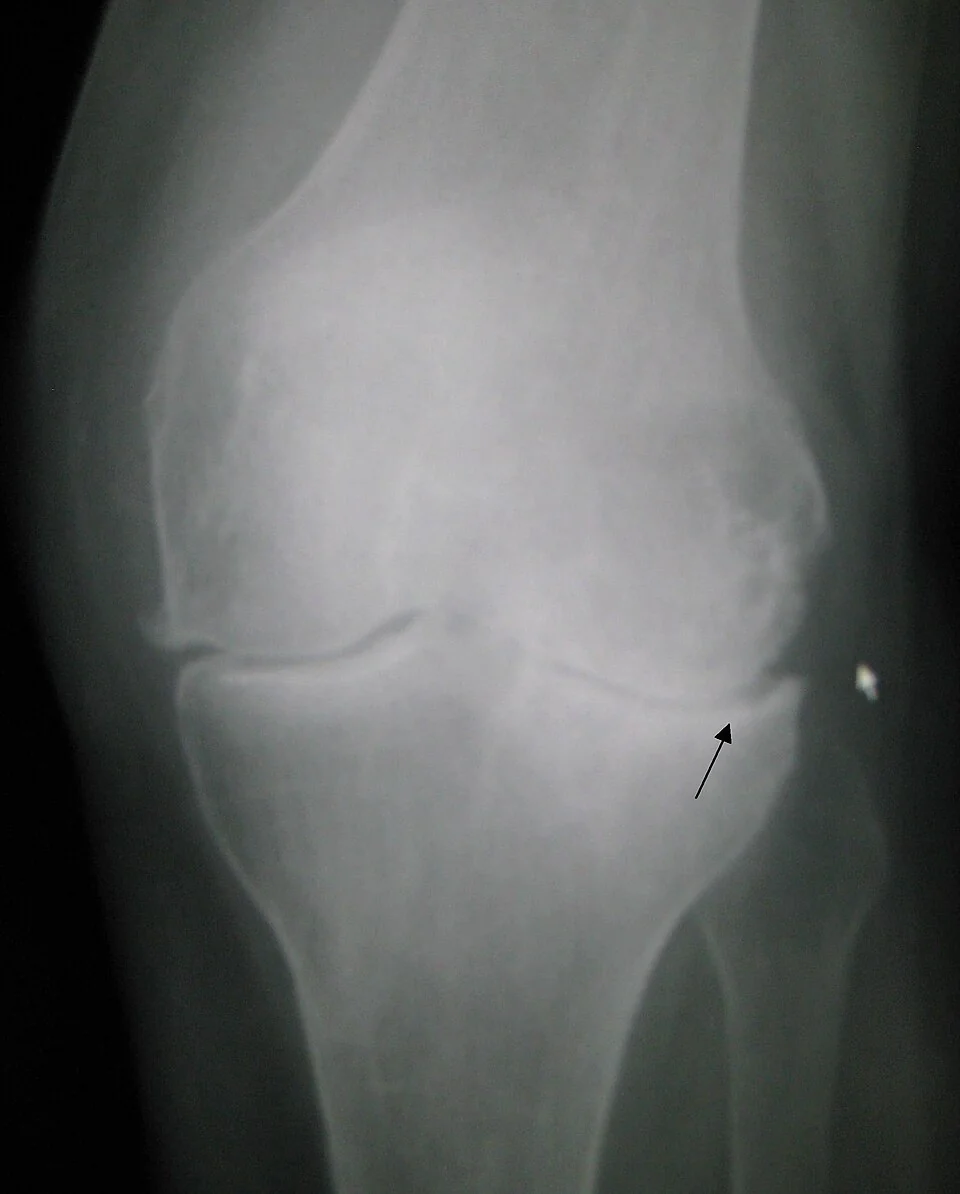 Anteroposterior radiograph of a left knee showing narrowing of the medial joint space, increased density of the bone immediately beneath the joint surface, and bony spurs projecting from the joint margins.
