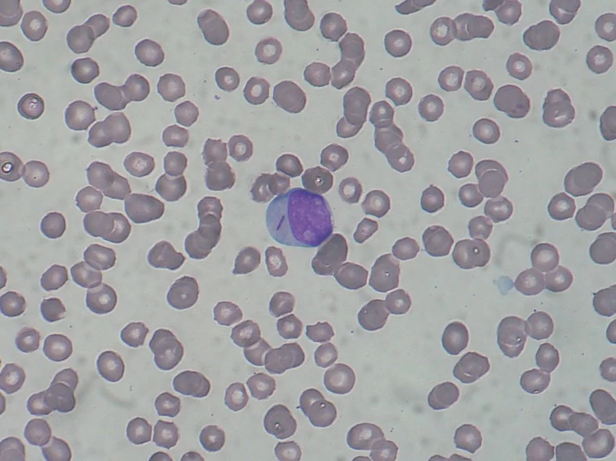 Peripheral blood film showing a myeloblast containing a needle-shaped Auer rod in its cytoplasm.