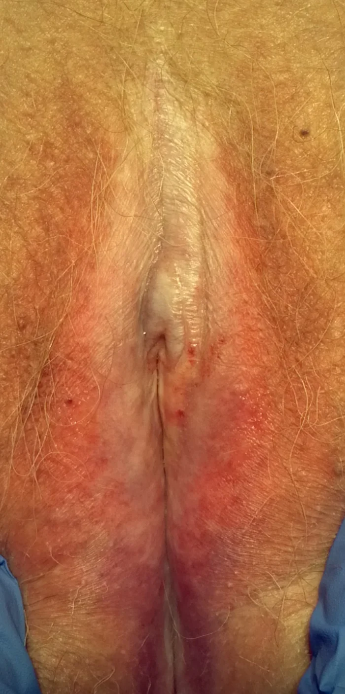 Clinical photograph of the vulva showing ivory-white, atrophic skin changes of lichen sclerosus extending from the vulva to the perineum.