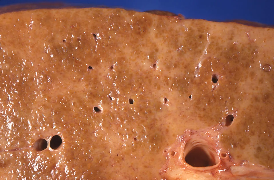 Gross pathology specimen of a cirrhotic liver showing a diffusely nodular surface with fibrous bands replacing the smooth normal architecture.