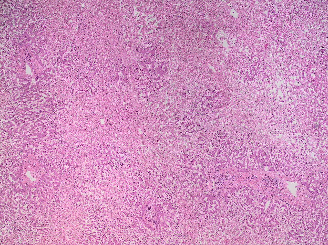Liver histology showing necrosis of hepatocytes concentrated around the central vein, with preservation of the periportal hepatocytes.