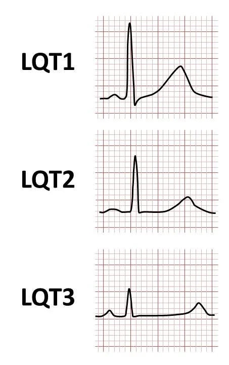 Three stacked ECG complexes labelled LQT1, LQT2 and LQT3. LQT1 shows a broad-based T wave, LQT2 a low-amplitude notched T wave, and LQT3 a long flat ST segment followed by a late narrow T wave.