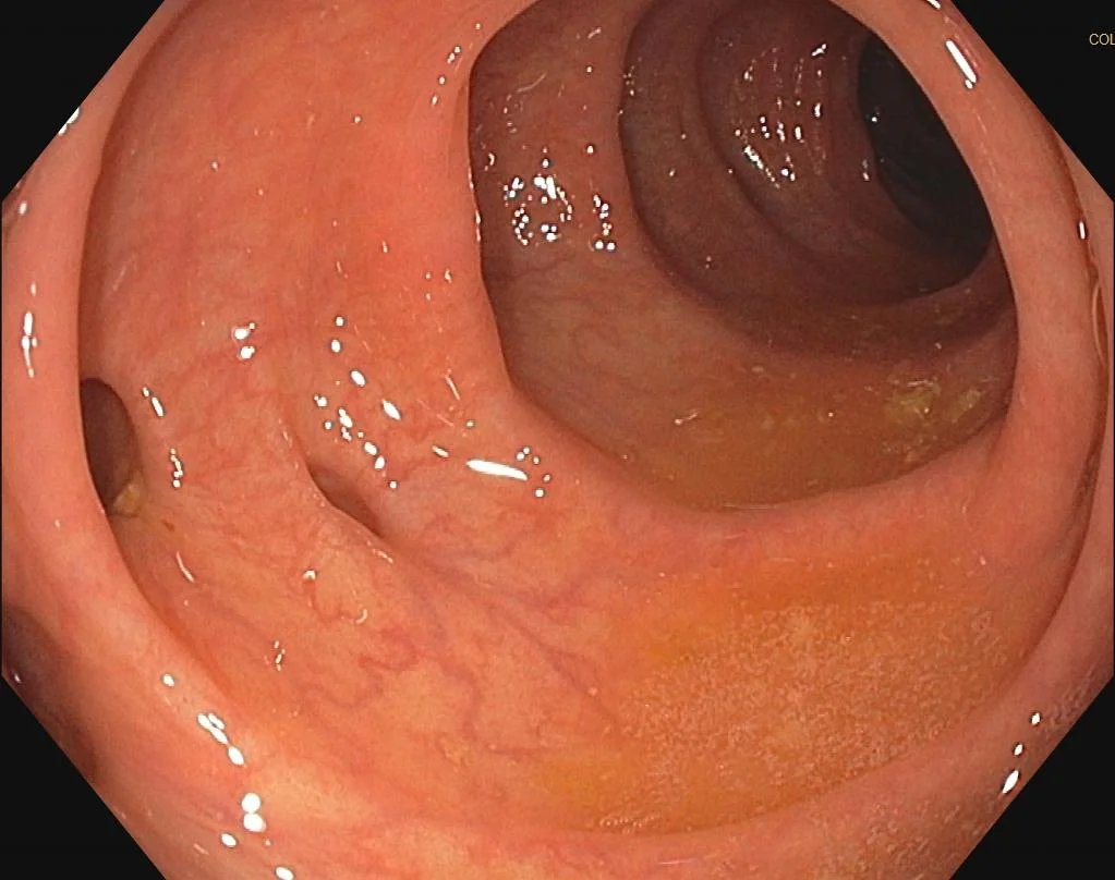 Endoscopic image of the colon showing two diverticular openings in the mucosal wall.