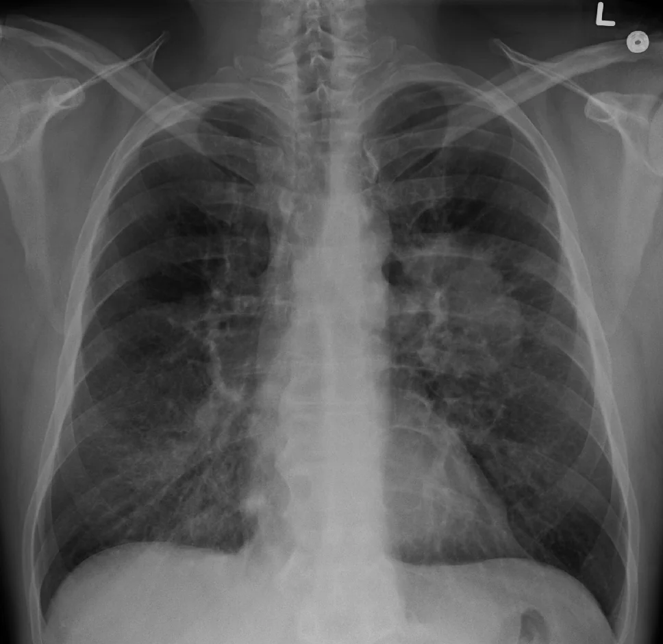 Frontal chest radiograph showing a rounded soft tissue mass with irregular margins in the right lower zone adjacent to the right heart border, on otherwise reasonably aerated lungs.