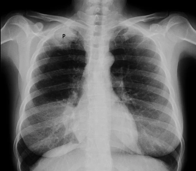 Frontal chest radiograph with the letter P marking an area of increased density at the apex of the right lung, above the level of the clavicle.