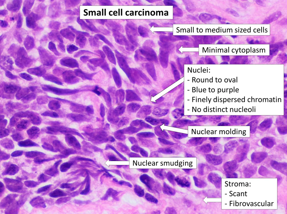 Annotated haematoxylin and eosin micrograph of small cell carcinoma with labels pointing to small to medium sized cells, minimal cytoplasm, round to oval nuclei with finely dispersed chromatin and no distinct nucleoli, nuclear moulding, nuclear smudging, and scant fibrovascular stroma.