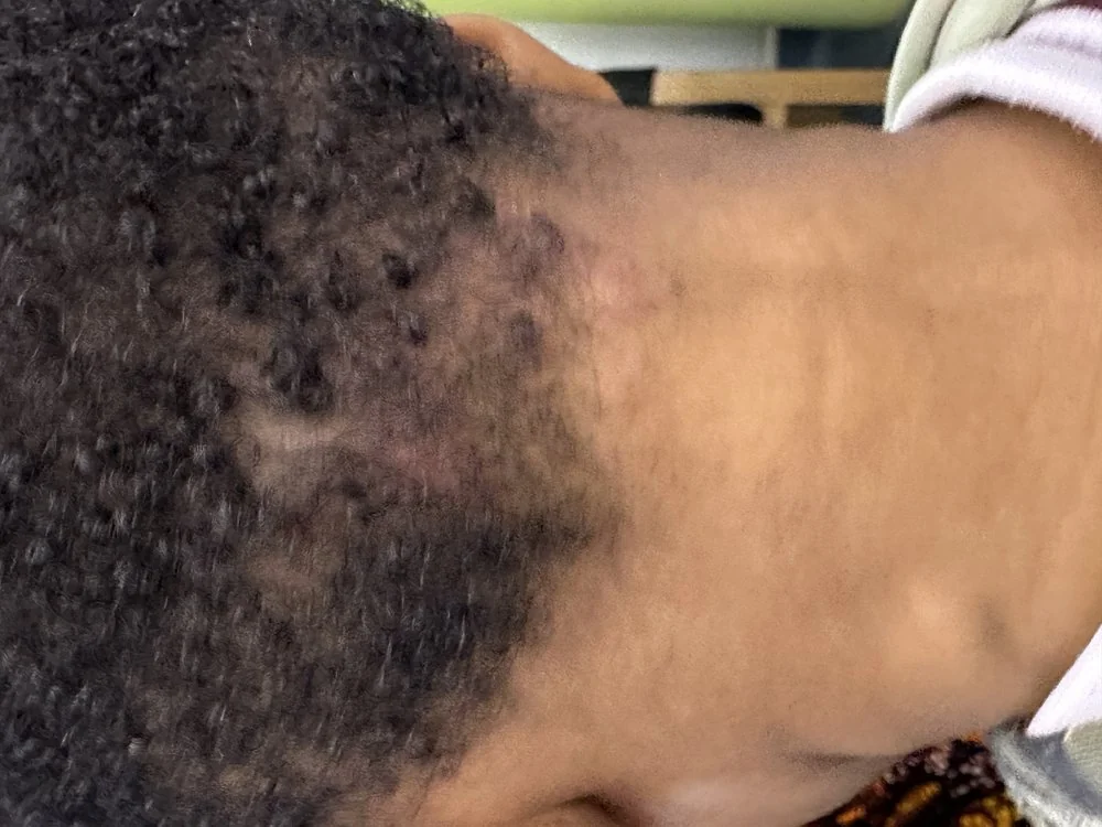 Photograph of a patient with a visible swelling in the neck due to cervical lymphadenopathy.