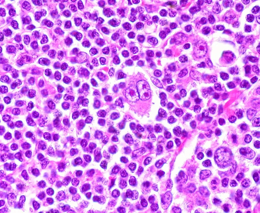 Micrograph showing a large, binucleate Reed-Sternberg cell with prominent nucleoli among smaller reactive lymphocytes.