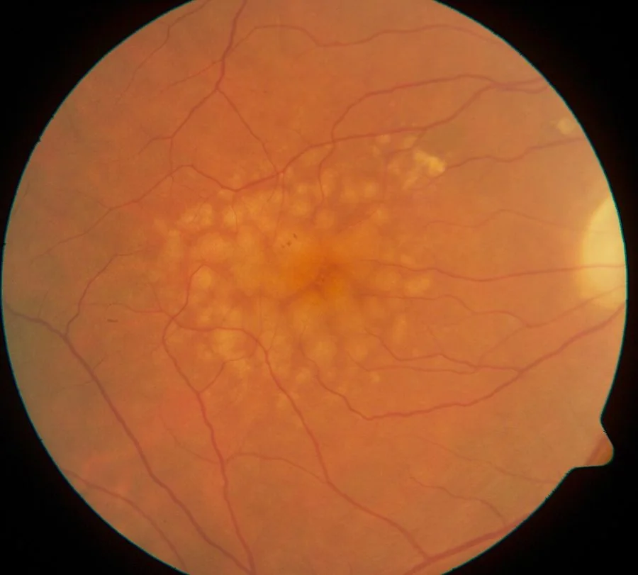 Colour fundus photograph of a right eye showing multiple pale yellowish soft drusen with indistinct borders clustered at the macula, between the optic disc and the temporal retina.