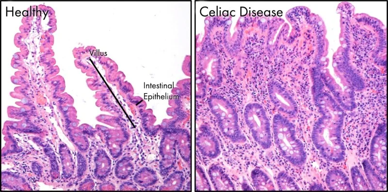 Duodenal biopsy histology showing flattened villi with elongated crypts, the villous atrophy that reduces absorptive surface area.