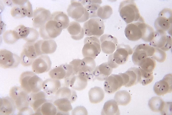 Light micrograph of a blood smear showing numerous red blood cells infected with ring-form Plasmodium falciparum parasites.