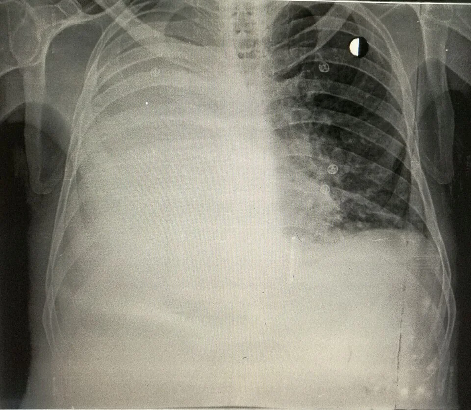 Frontal chest radiograph showing dense homogeneous opacification of the lower part of one hemithorax with a curved upper border rising towards the axilla, obscuring the costophrenic angle and hemidiaphragm.