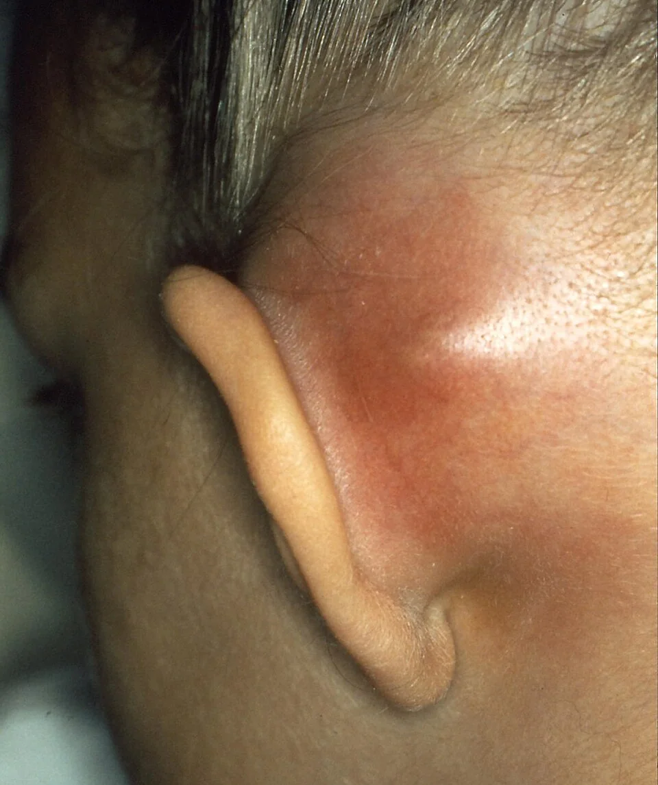 Photograph showing a subperiosteal abscess in mastoiditis, with marked post-auricular swelling and inferolateral displacement of the pinna.