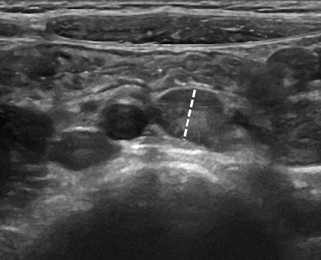 Abdominal ultrasound image showing several rounded, dark hypoechoic lymph nodes clustered in the mesentery, with calliper markers measuring the largest.