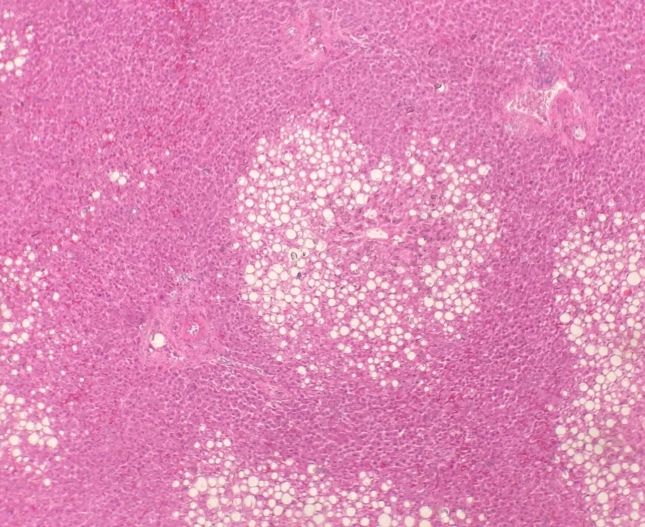 Liver histology showing hepatocytes distended by large clear fat vacuoles that displace the nuclei to the cell periphery, the appearance of macrovesicular steatosis.