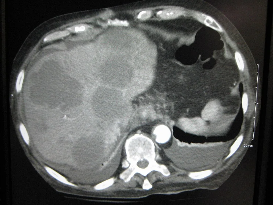 Axial contrast-enhanced CT of the upper abdomen showing multiple rounded low-attenuation lesions scattered throughout an enlarged liver, consistent with metastatic deposits.