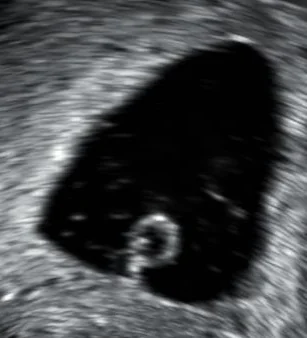Transvaginal ultrasound showing a gestational sac containing a yolk sac but no embryo.