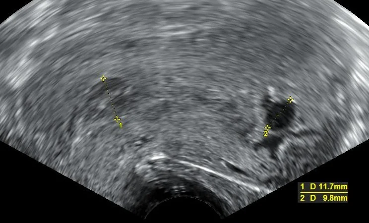 Transvaginal ultrasound showing products of conception in the cervix and remnants of a gestational sac at the uterine fundus.