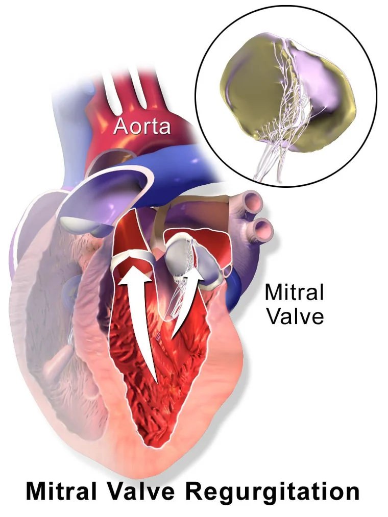 Cutaway illustration of the heart showing the mitral valve failing to close in systole, with an arrow indicating blood flowing backwards from the left ventricle into the dilated left atrium.