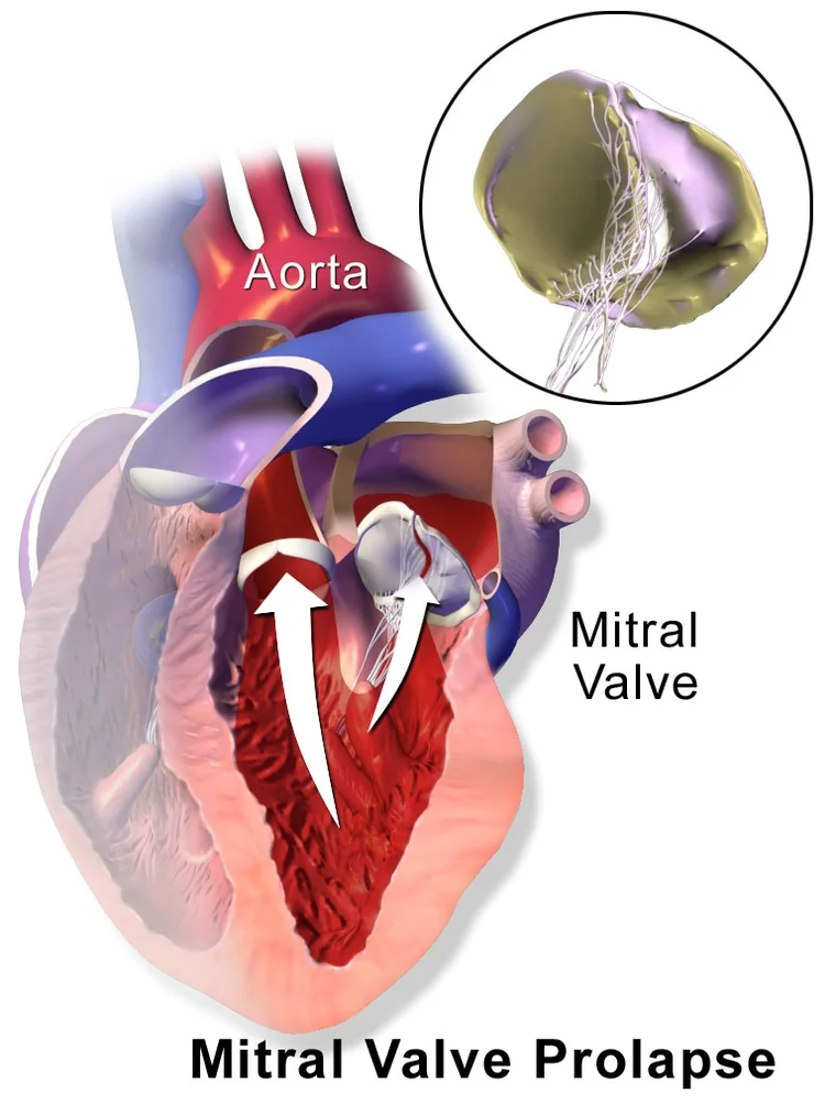 Cutaway illustration of the heart showing a mitral valve leaflet billowing upwards into the left atrium during systole instead of meeting its opposing leaflet.