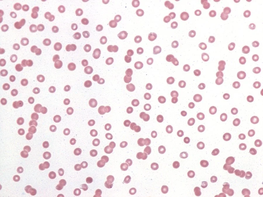 Peripheral blood film showing rouleaux formation, with red blood cells stacked together like coins, seen in multiple myeloma.