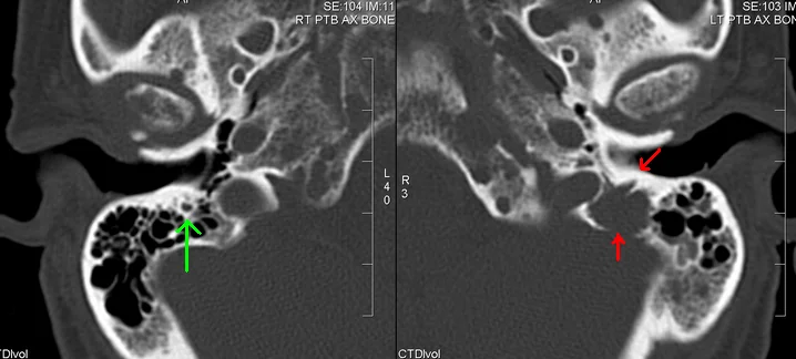 CT image of the skull showing a lytic lesion in the temporal bone, consistent with a myeloma deposit.
