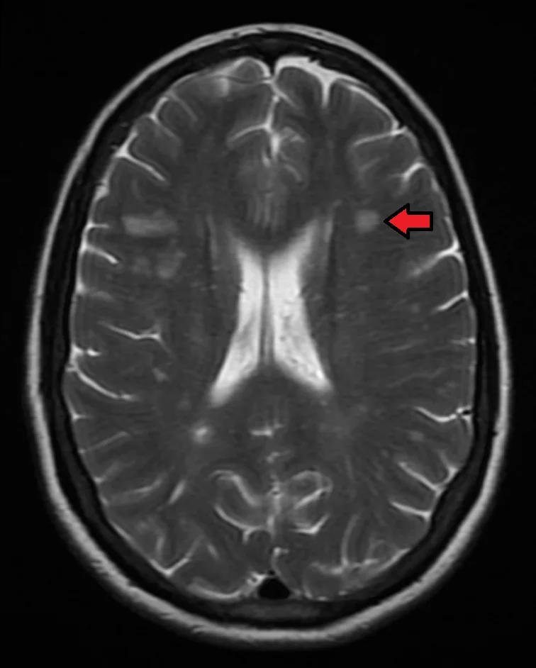 Axial T2-weighted MRI brain scan showing areas of high signal intensity in the periventricular white matter bilaterally, with a red arrow marking one lesion adjacent to the left lateral ventricle.