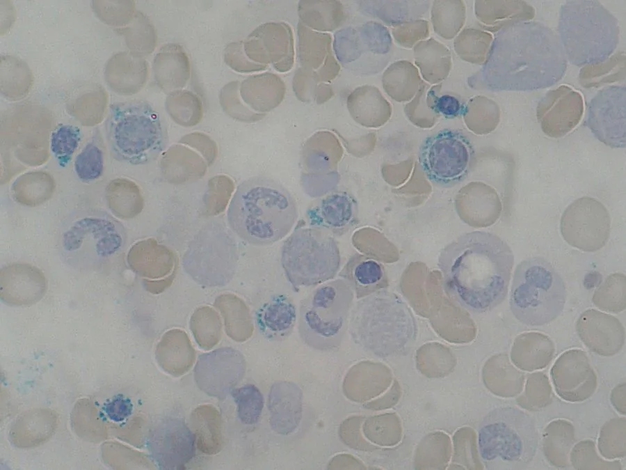 Bone marrow smear showing ring sideroblasts, red cell precursors with a perinuclear ring of iron-laden mitochondria.