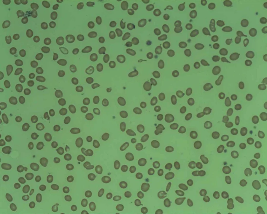 Peripheral blood film showing teardrop-shaped red blood cells (dacrocytes), characteristic of myelofibrosis.