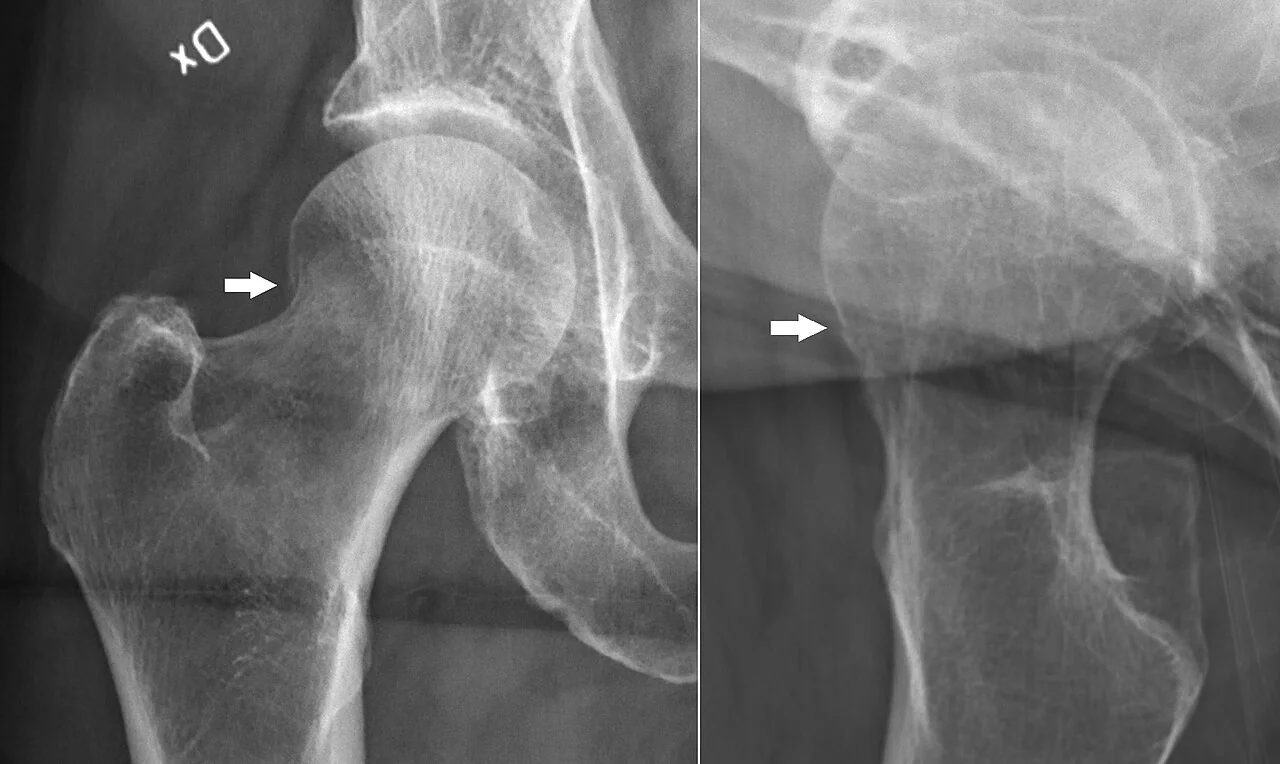 Annotated anteroposterior pelvic radiograph of an elderly patient, with markings highlighting a subtle mildly compressed fracture of the left femoral neck compared with the normal contralateral hip.