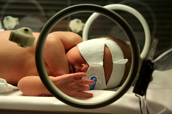 A naked newborn baby lying under a blue phototherapy light with soft opaque padding covering the eyes.