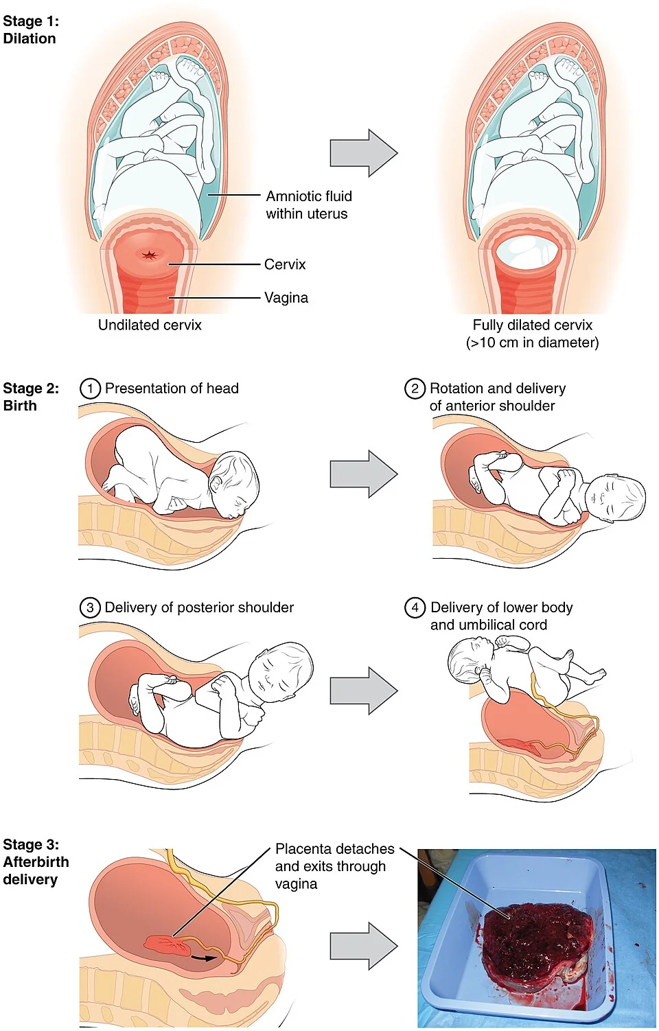 Illustration of the three stages of labour: cervical dilatation, birth of the head and shoulders, and delivery of the placenta.