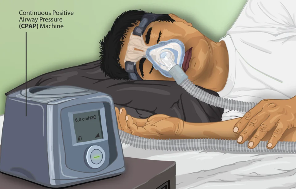 Illustration of a person asleep on their side wearing a nasal CPAP mask secured by head straps, connected by flexible tubing to a bedside CPAP machine whose display reads 6.0 cmH2O.