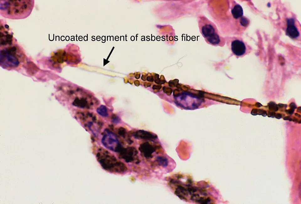 Light micrograph of lung tissue showing a long straight fibre coated along its length with beaded golden-brown iron-protein deposits, with an arrow indicating an uncoated transparent segment of the underlying fibre, surrounded by pigmented macrophages.