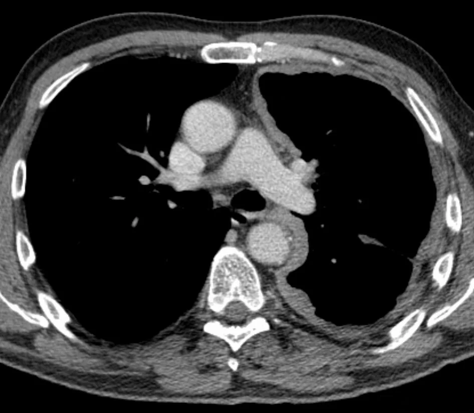 Axial CT of the chest showing the left pleura thickened in a continuous rind that encircles the lung including its mediastinal surface, with associated pleural fluid and a smaller left hemithorax compared with the right.