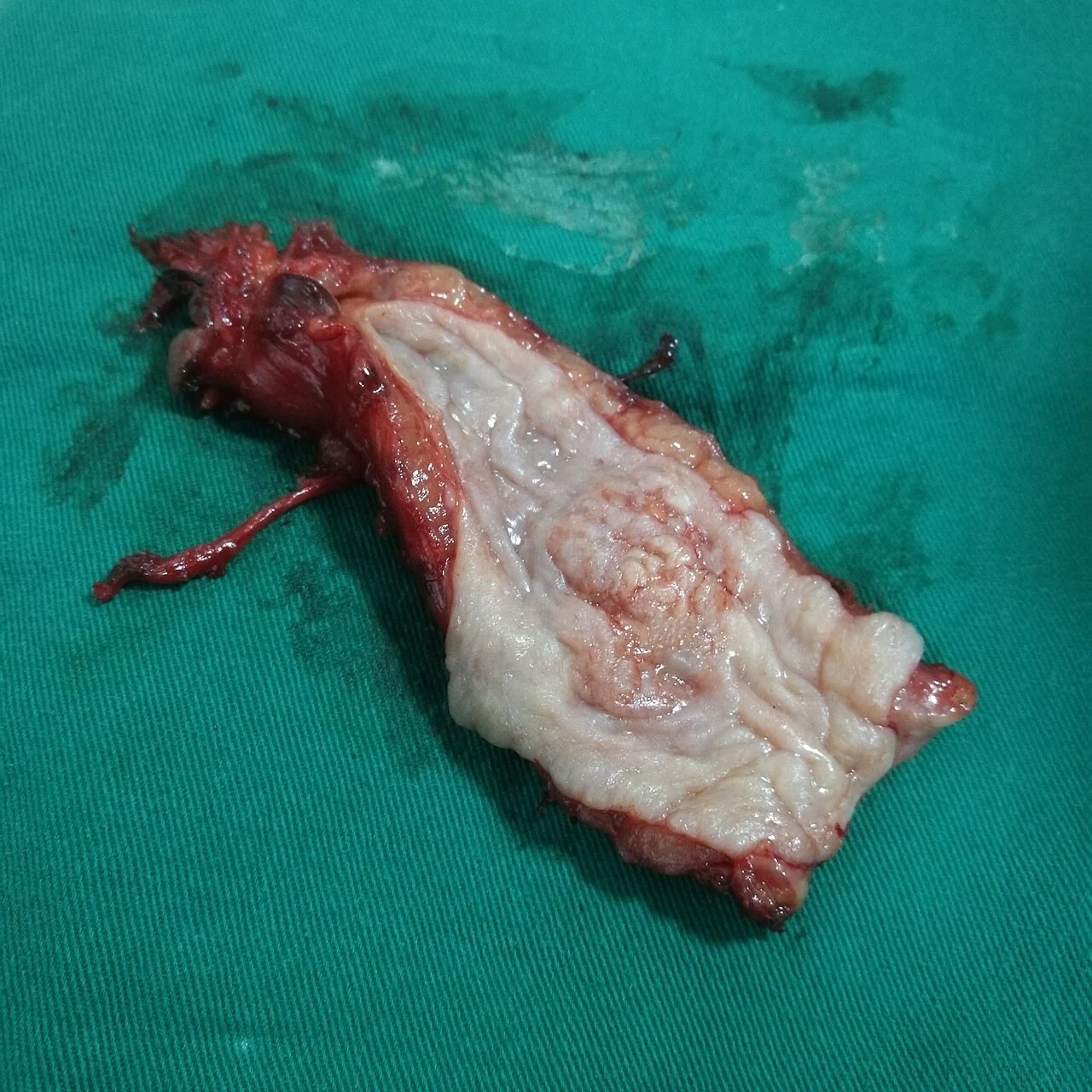Resected oesophageal specimen showing an ulcerated, irregular tumour narrowing the lumen.