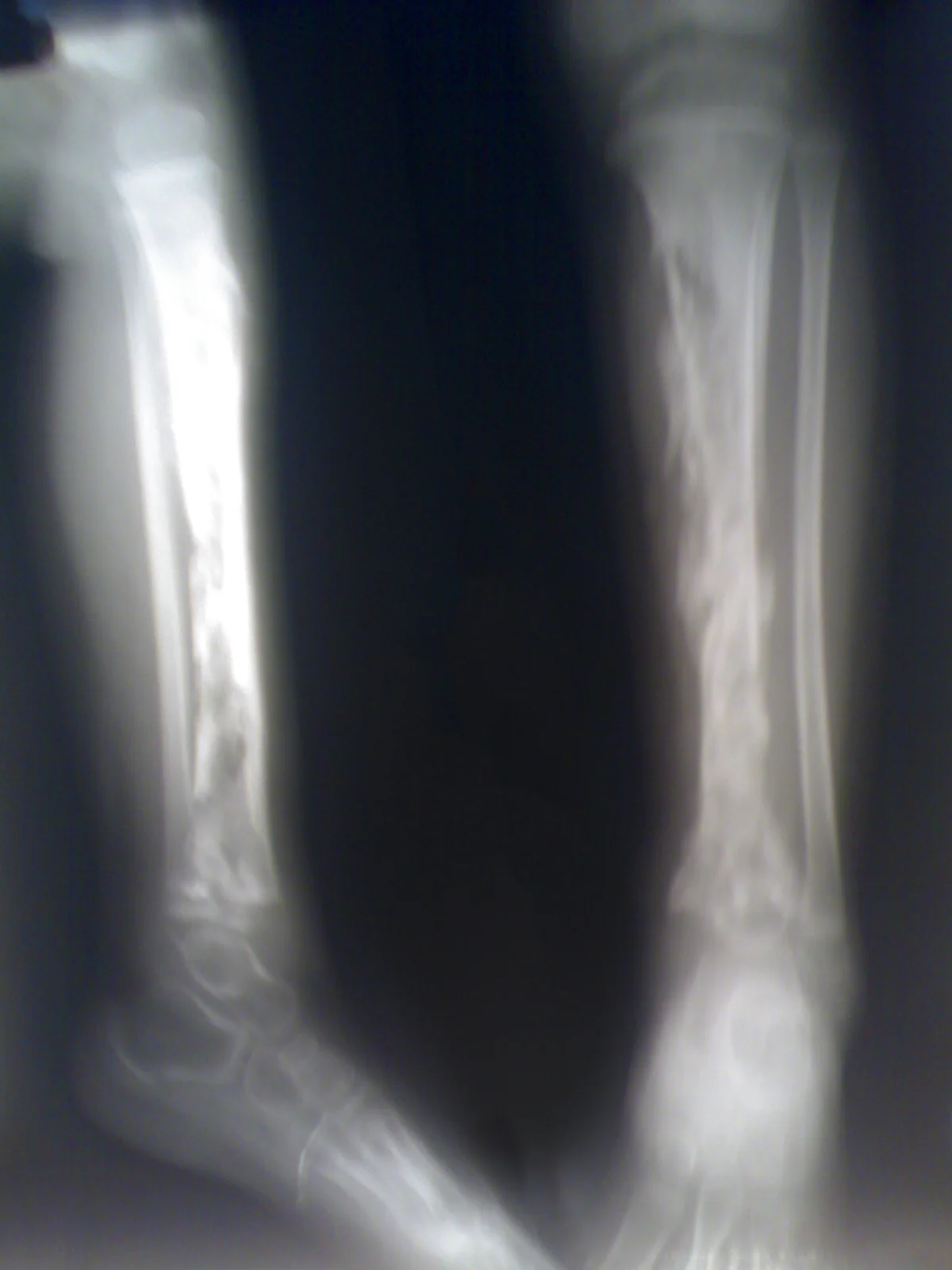 X-ray of a child's tibia showing multiple radiolucent abscess cavities within the bone, characteristic of osteomyelitis.