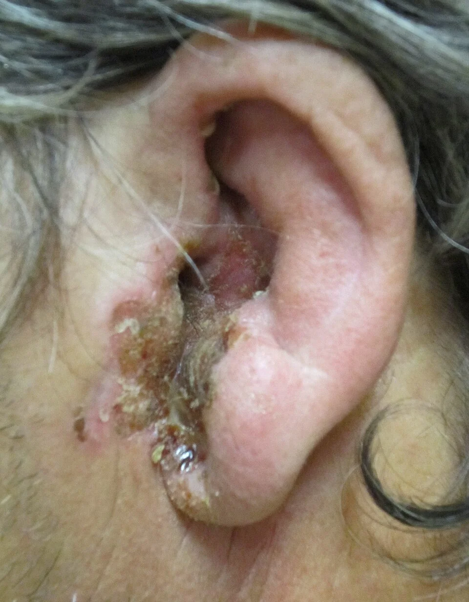 Photograph of a severe case of otitis externa showing marked erythema and swelling of the external ear and surrounding skin.