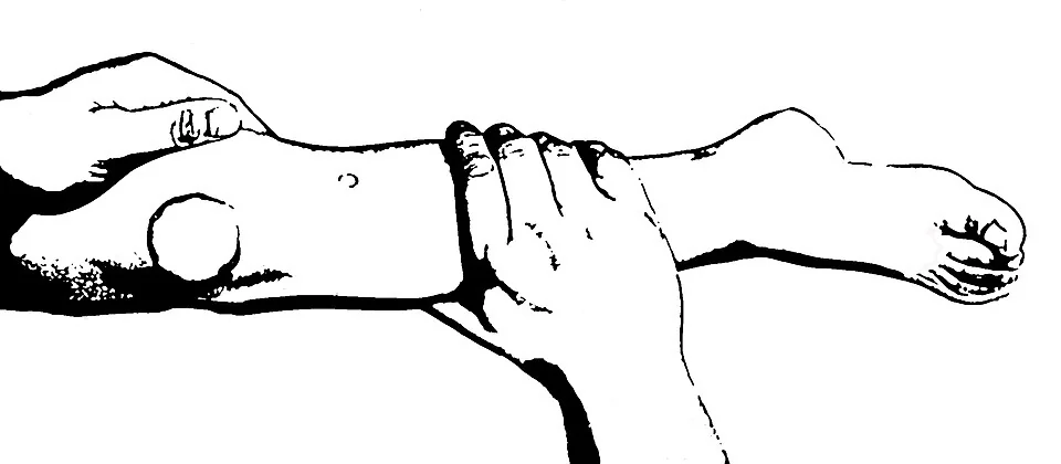 Photograph of a child's lower leg with the landmark for proximal tibial intraosseous insertion indicated, on the flat anteromedial surface just below and medial to the tibial tuberosity.