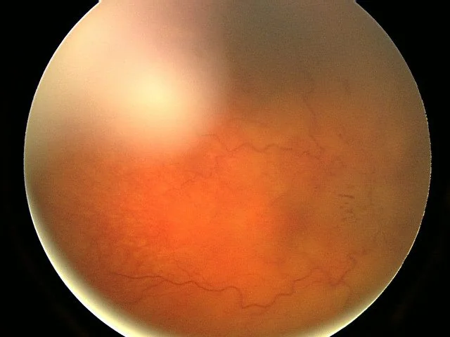 Colour fundus photograph of a right eye showing severe papilloedema, with a markedly swollen and hyperaemic optic disc, completely blurred disc margins, obliteration of the physiological cup and surrounding retinal haemorrhages.