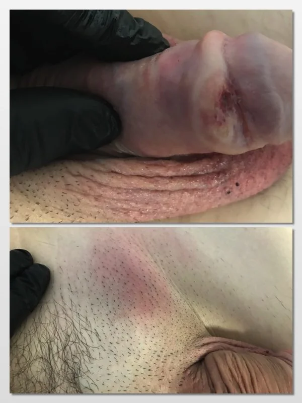 Clinical photograph showing an ulcerated fungating tumour involving the glans penis, together with visible swelling of the left inguinal region from enlarged lymph nodes.
