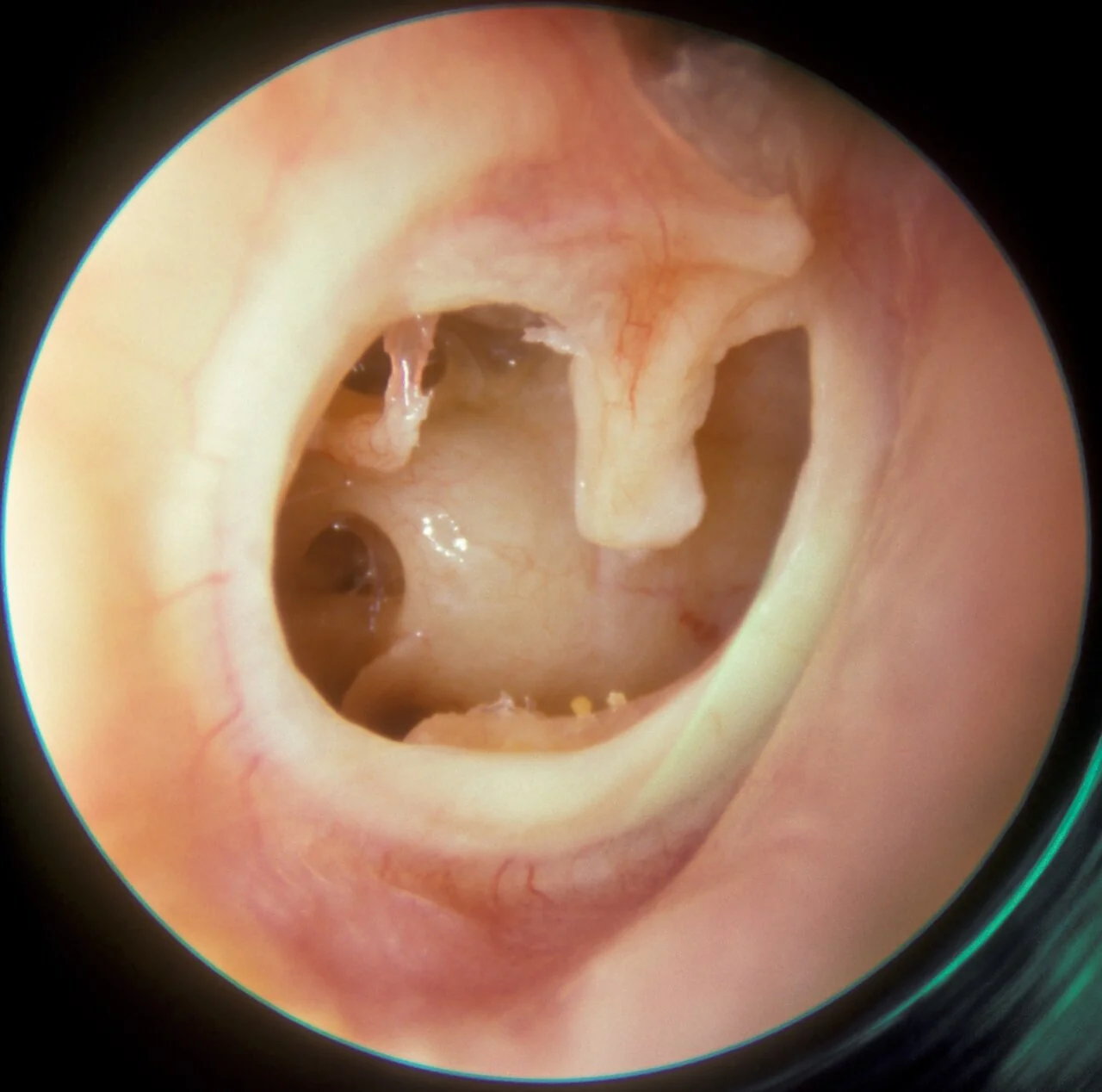 Otoscopic view of a subtotal perforation of the right tympanic membrane following a previous severe episode of acute otitis media.