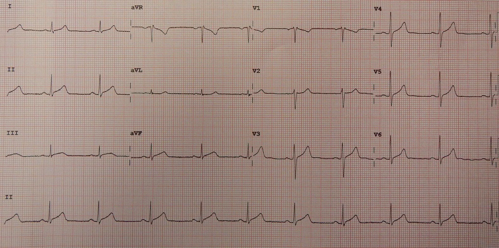 A second 12-lead ECG in pericarditis, showing only slight ST elevation spread across many leads, illustrating a more subtle presentation than the classical example.