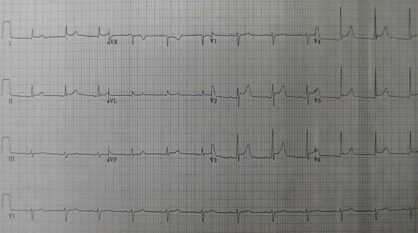 A 12-lead ECG in acute pericarditis, showing concave saddle-shaped ST elevation across multiple leads that do not correspond to a single coronary territory, with reciprocal ST depression in lead aVR.