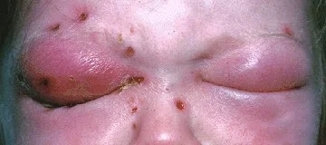 Photograph of a patient with orbital cellulitis, showing marked swelling and redness of the eyelids of one eye with the lid held closed by oedema, compared with the normal fellow eye.