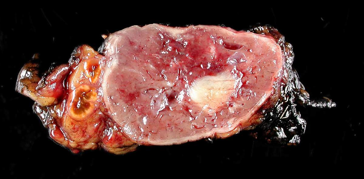 Cut surface of a resected adrenal gland showing a well-circumscribed, fleshy tan-brown tumour replacing the adrenal medulla, with a thin rim of normal yellow adrenal cortex visible at the margin.