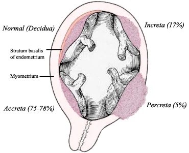 Diagram showing the depth of placental invasion in accreta, increta and percreta.