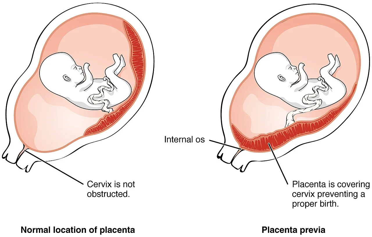 Diagram contrasting a normally sited fundal placenta with a placenta praevia covering the internal cervical os.