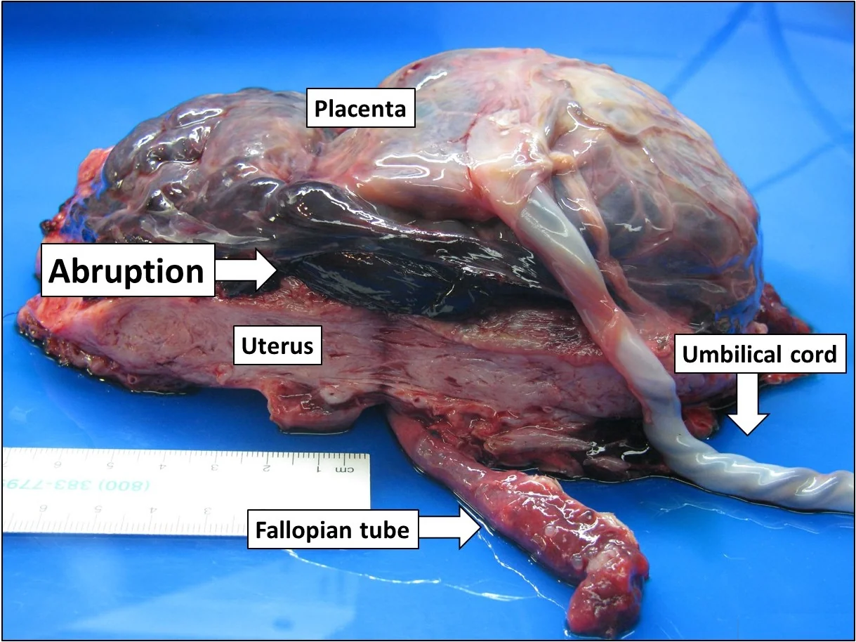 Opened uterus at gross pathology showing a haematoma separating the placenta from the uterine wall.