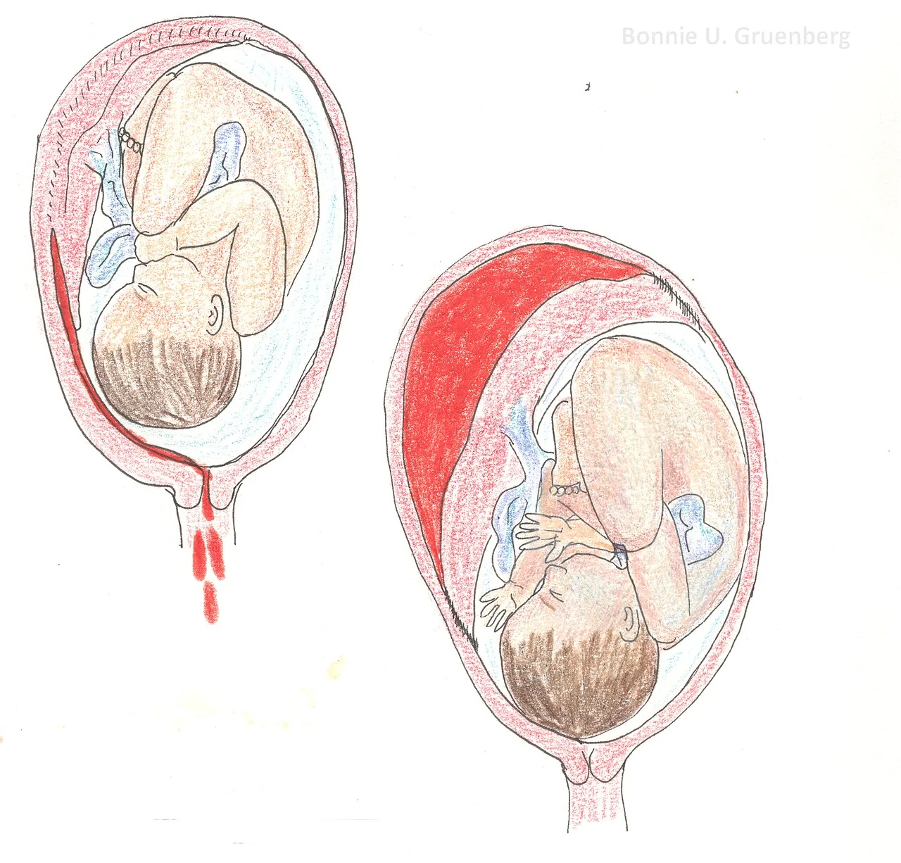 Illustration comparing a marginal revealed abruption with blood escaping through the cervix and a concealed abruption with blood retained behind the placenta.